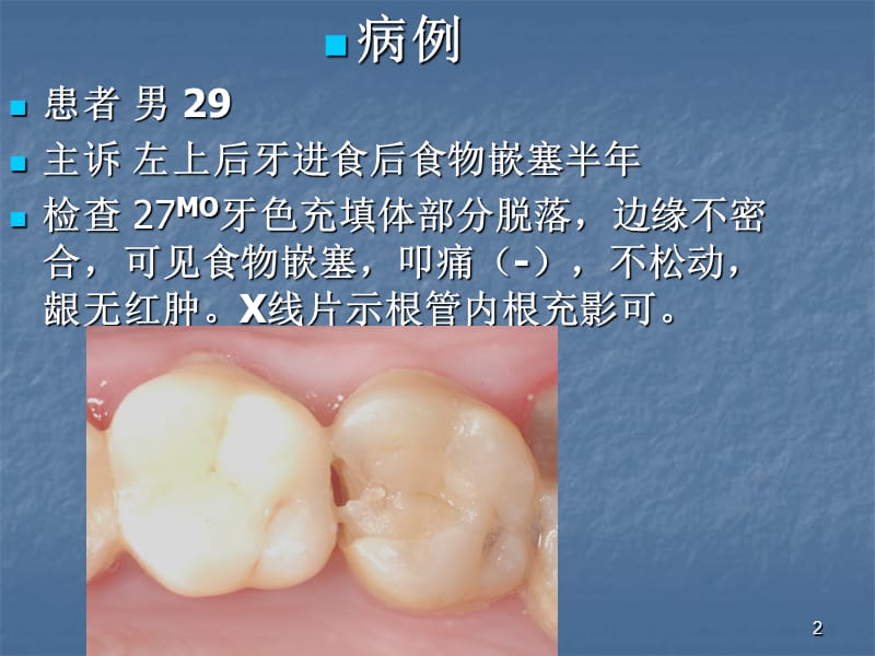 分段成型片的临床应用 北大口腔（课堂PPT）_第2页