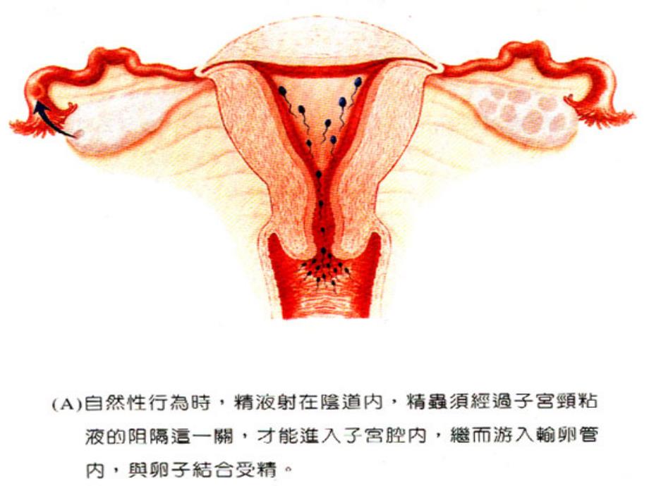 不孕症 PPT_第4页