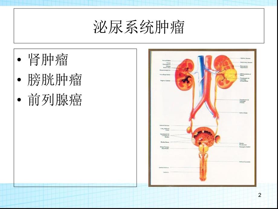 泌尿系统肿瘤(图文)PPT_第2页