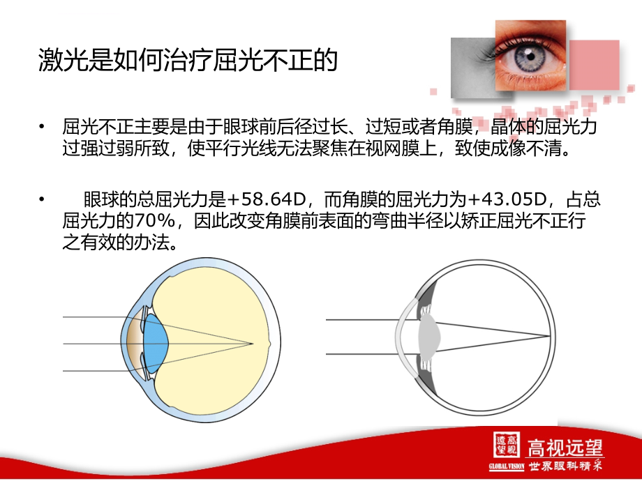 屈光激光介绍课件_第4页