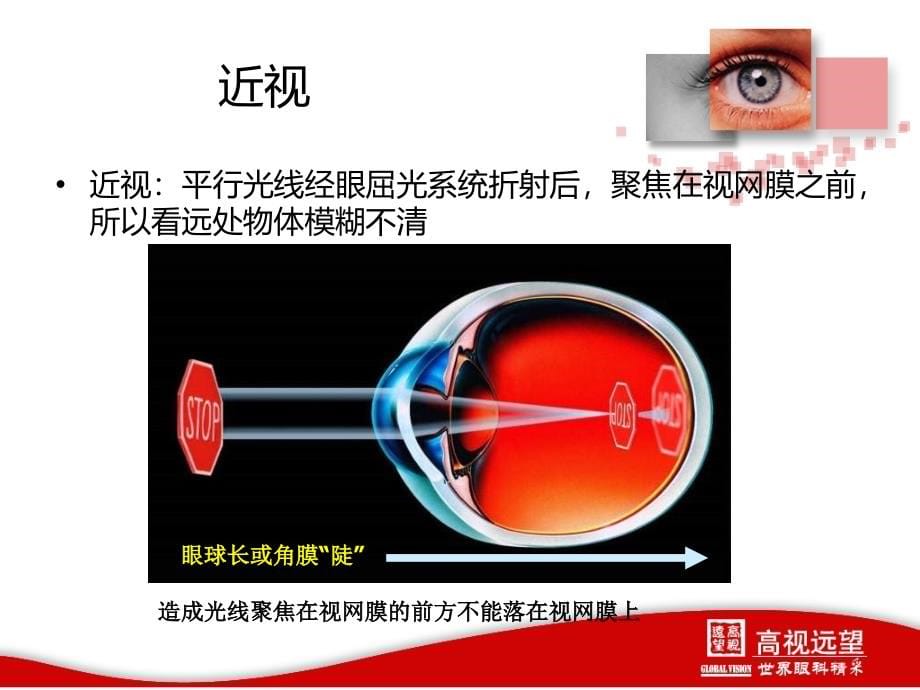 屈光激光介绍课件_第5页