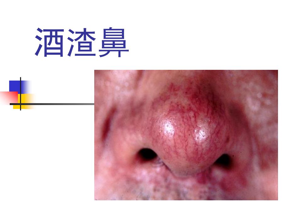 酒渣鼻讲义资料_第1页