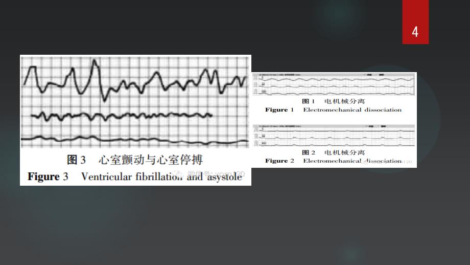 心电图危急值识别-文档资料_第4页