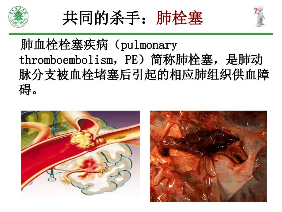 急性肺栓塞的CT表现课件_第4页