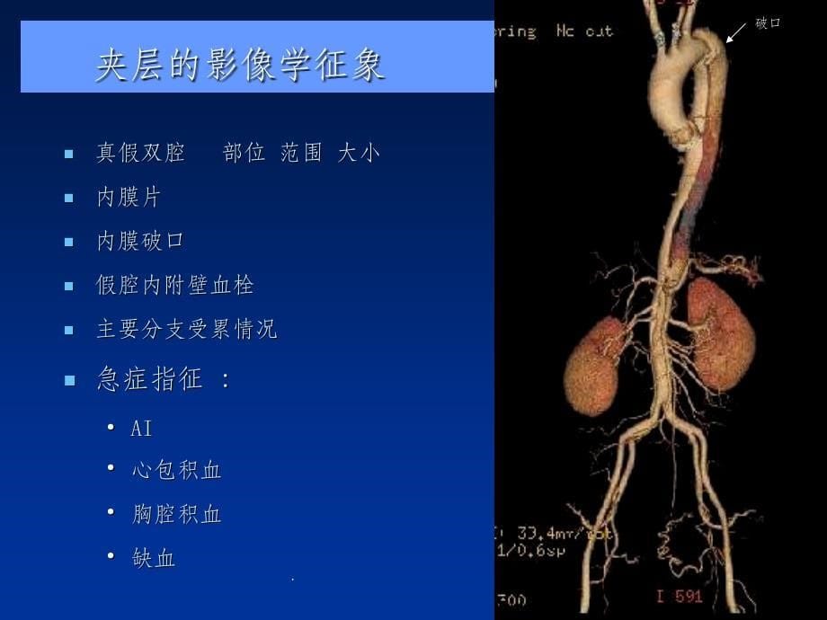 主动脉夹层、壁间血肿及穿通...ppt课件_第5页