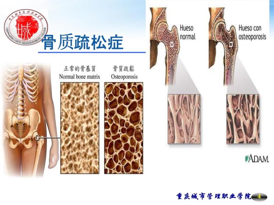 冉龙鑫骨质疏松症教学教材_第4页