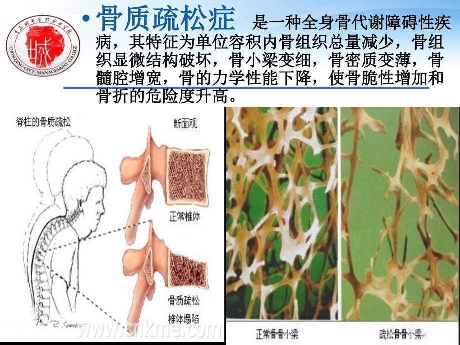 冉龙鑫骨质疏松症教学教材_第5页