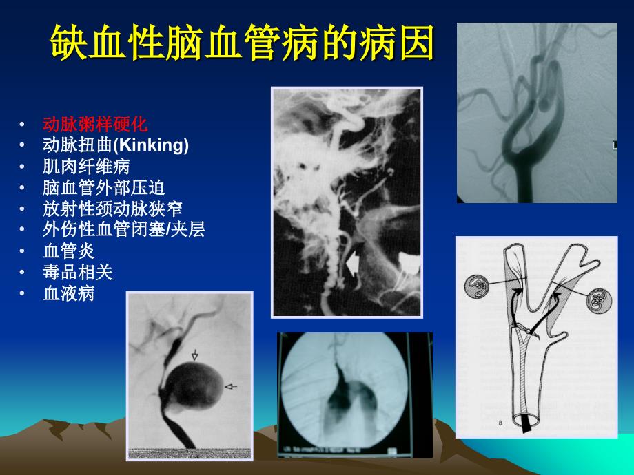 中国卒中患者CISS分型对治疗的临床意义电子教案_第3页