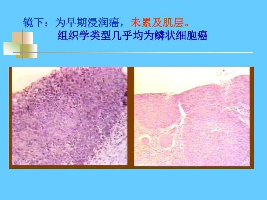 消化系统常见肿瘤(临床病理）_第5页