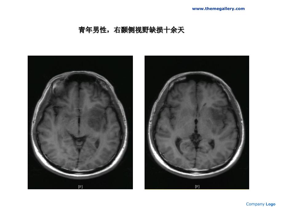 肿瘤样脱髓鞘病变幻灯片资料_第2页