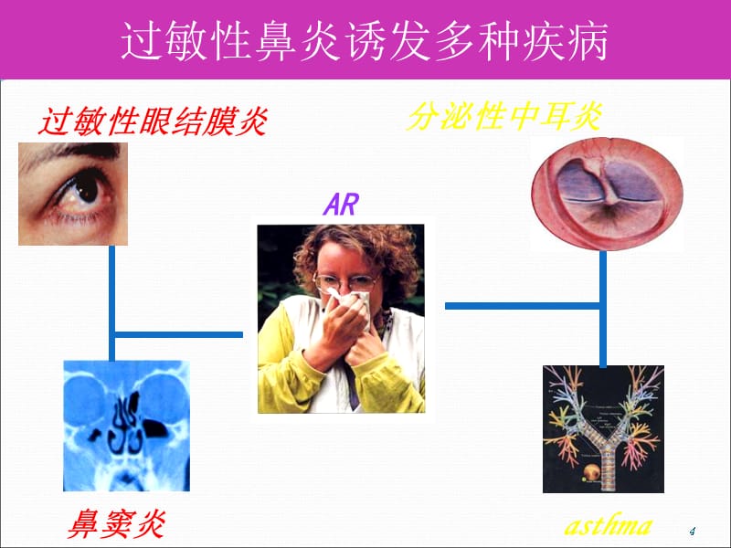 过敏性疾病(过敏性鼻炎)-文档资料_第4页