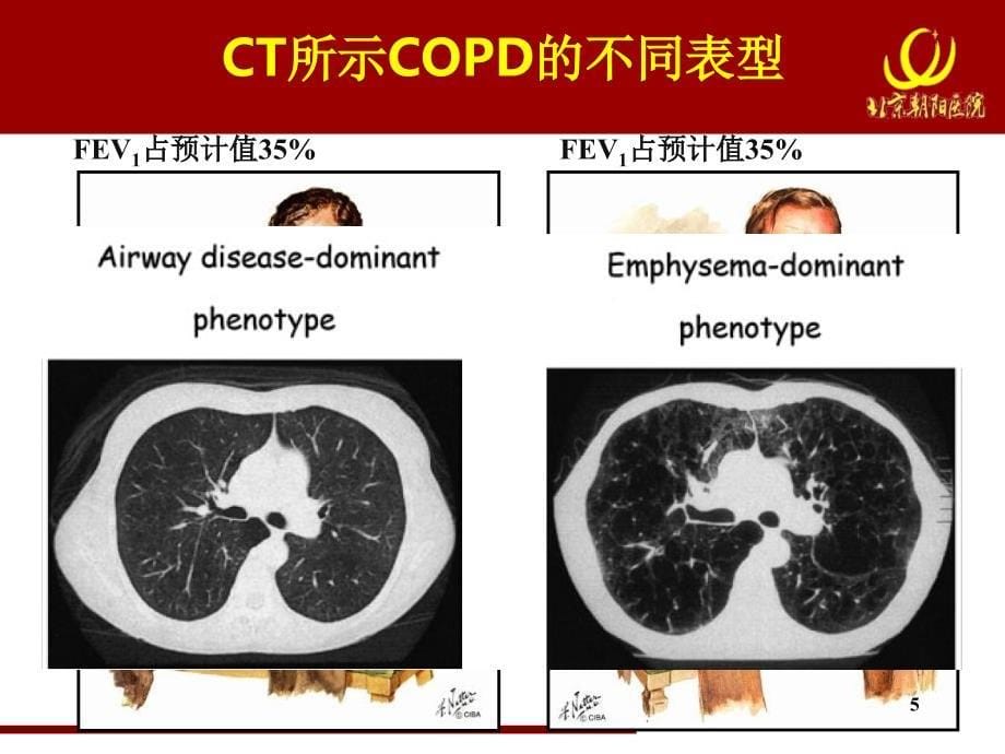 慢阻肺规范化诊治慢阻肺临床表型与治疗-文档资料_第5页