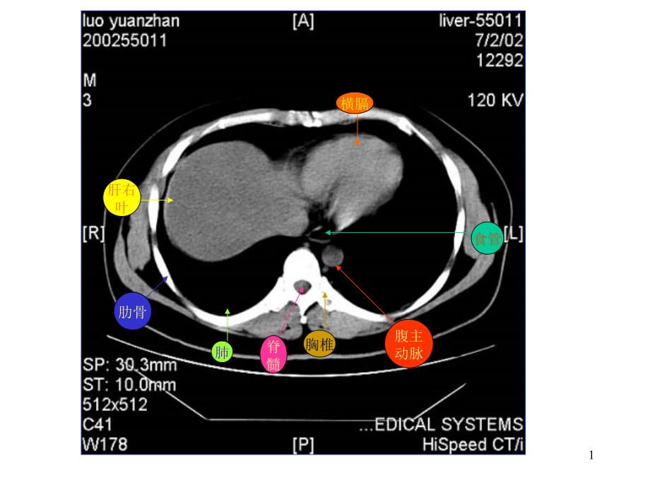 腹部CT解剖图示-文档资料_第1页