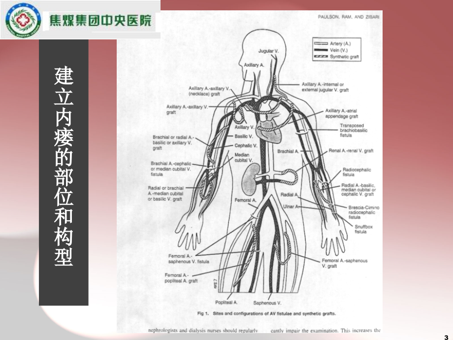 李正威内瘘血管评估使用和维护-文档资料_第3页