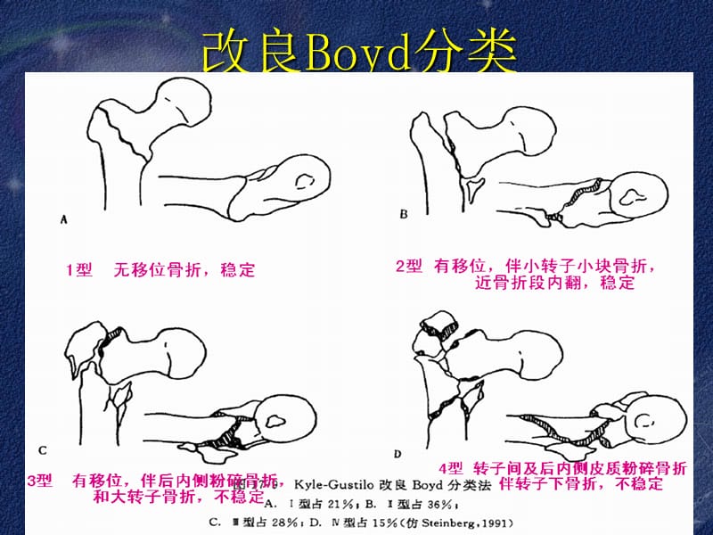 股骨转子间骨折的治疗-文档资料_第4页