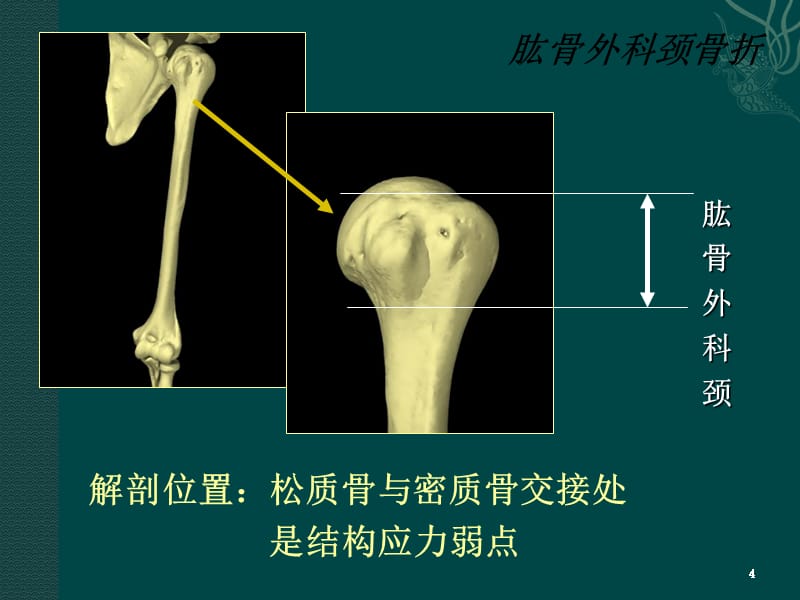 肱骨外科颈骨折-文档资料_第4页