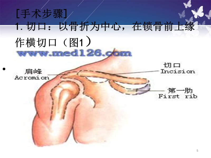 锁骨骨折切开内固定除术护理查房-文档资料_第5页