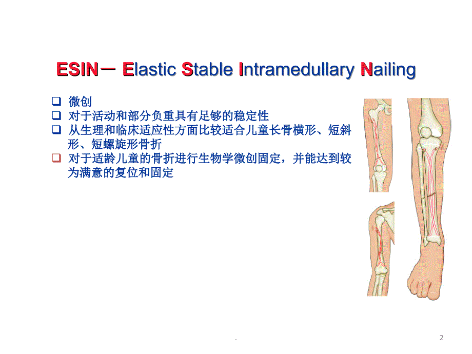 弹性髓内钉治疗儿童长骨骨折ppt课件_第2页