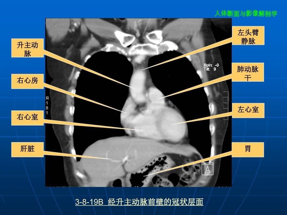 胸部冠状面矢状面解剖与影像-文档资料_第5页