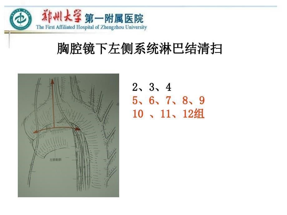 VATS左侧肺癌根治术中的淋巴结清扫-胸外科_第5页