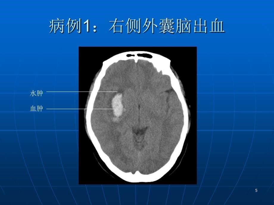脑卒中的CT诊断-文档资料_第5页