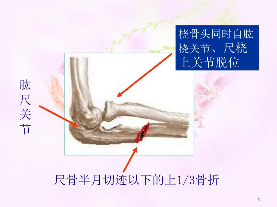 孟氏骨折的护理-文档资料_第4页