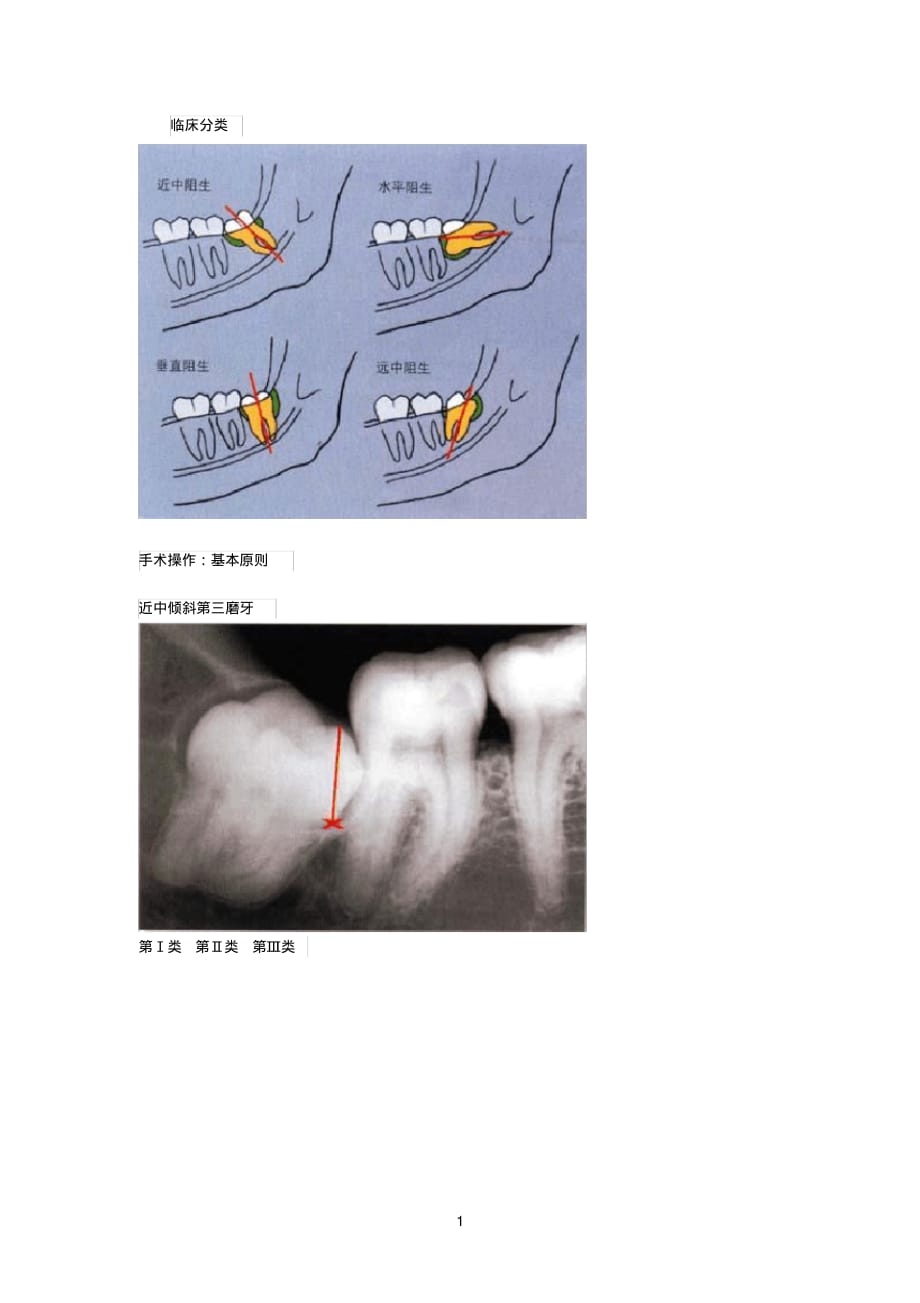拔牙技巧图解[整理]_第1页