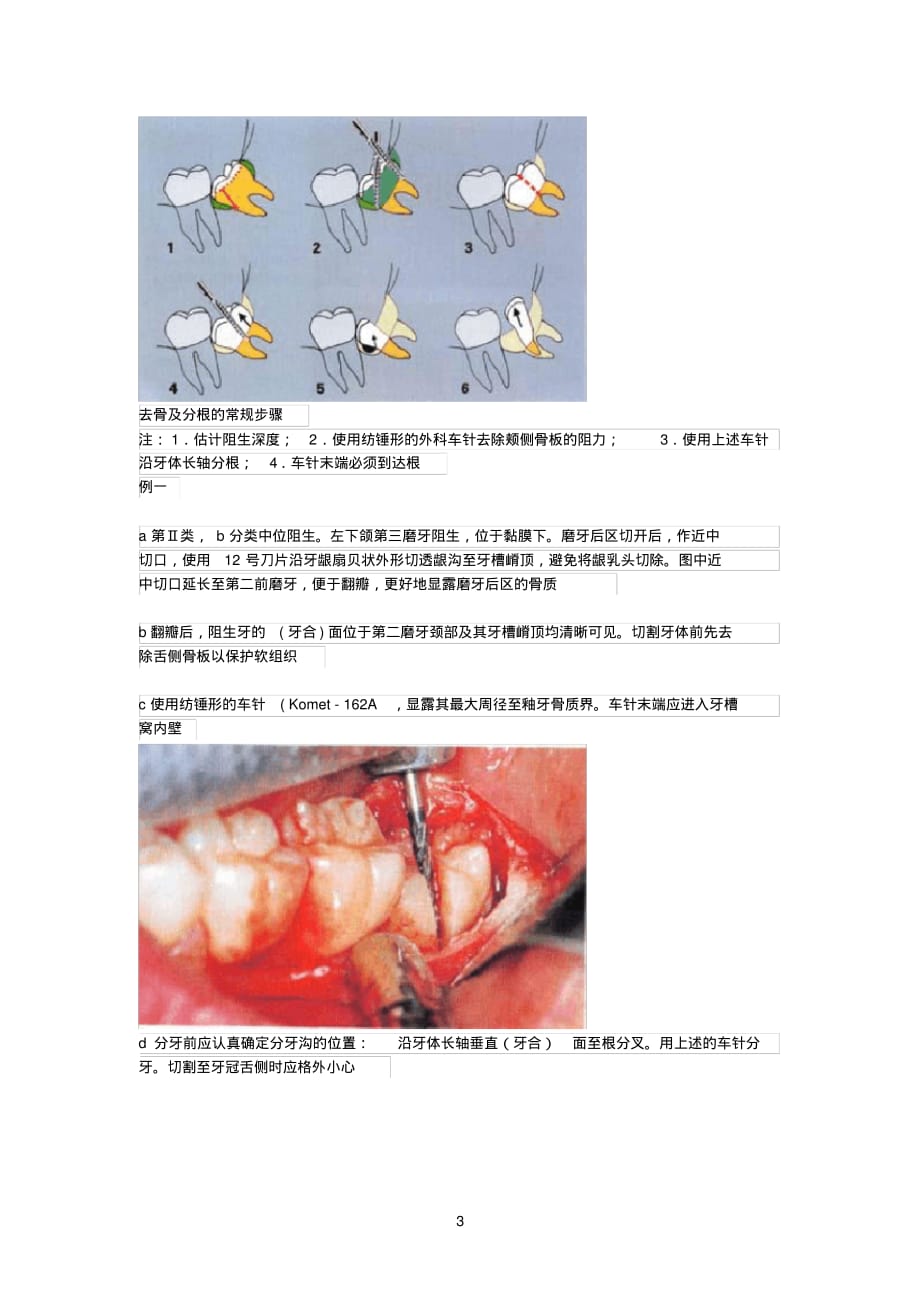 拔牙技巧图解[整理]_第3页