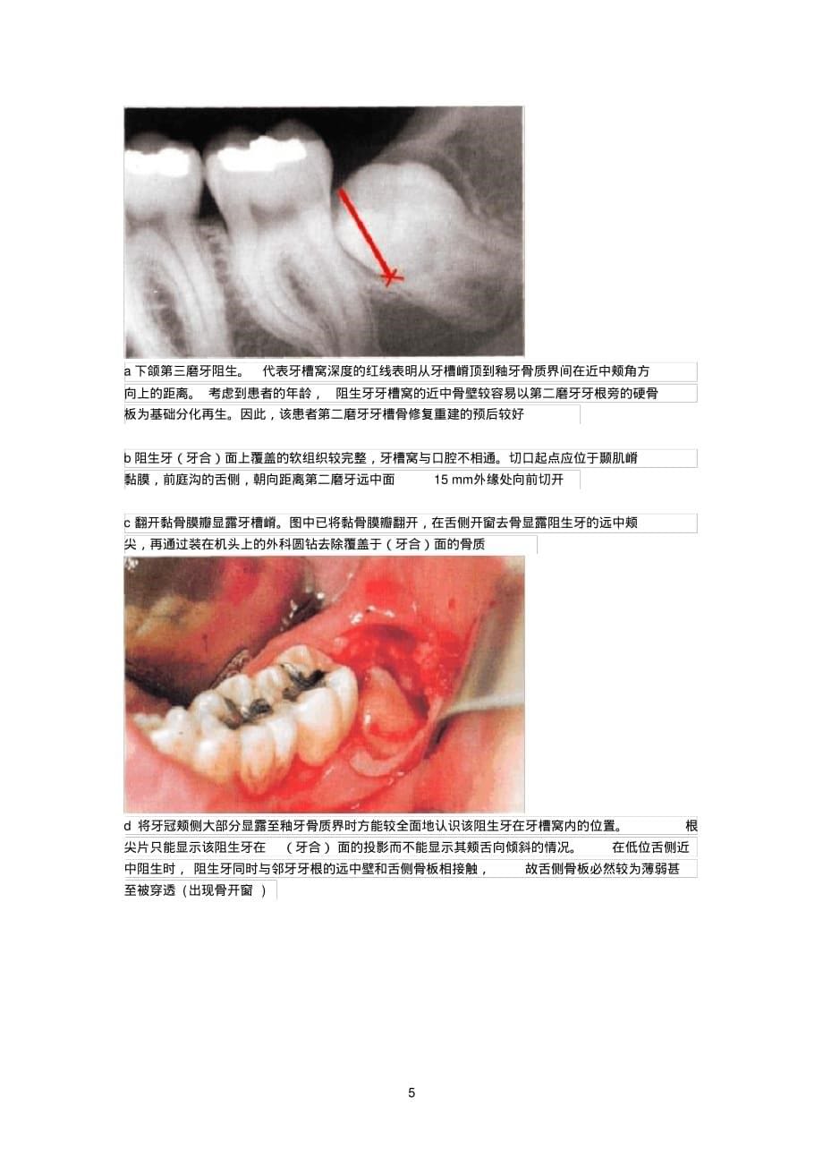 拔牙技巧图解[整理]_第5页