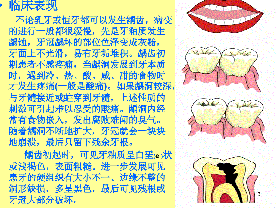口腔常见疾病-文档资料_第3页