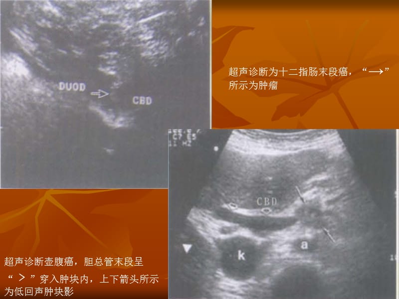 壶腹癌影像学诊断-文档资料_第5页