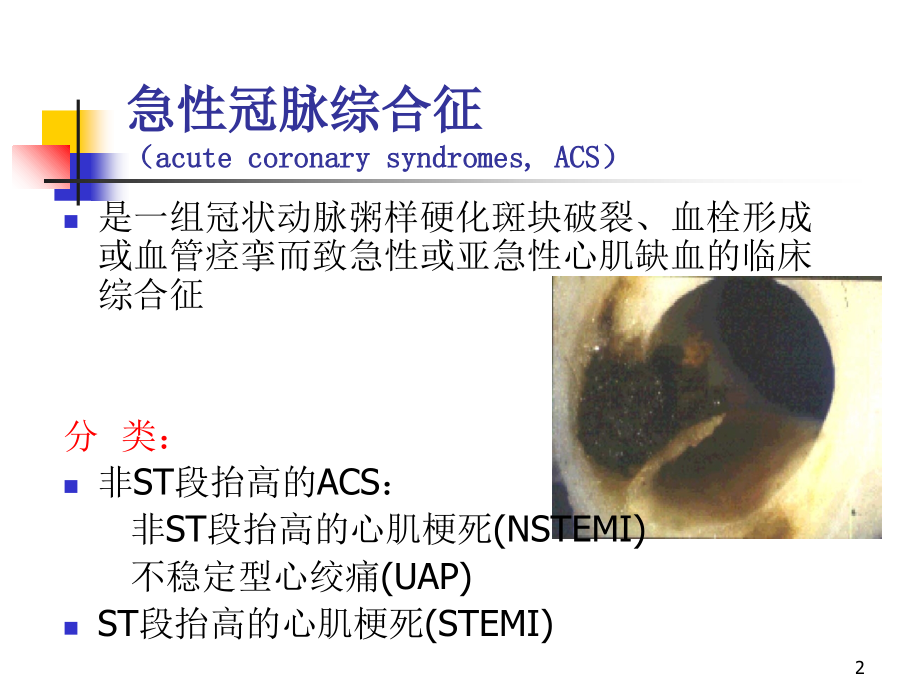 急性冠脉综合征的治疗策略-文档资料_第2页