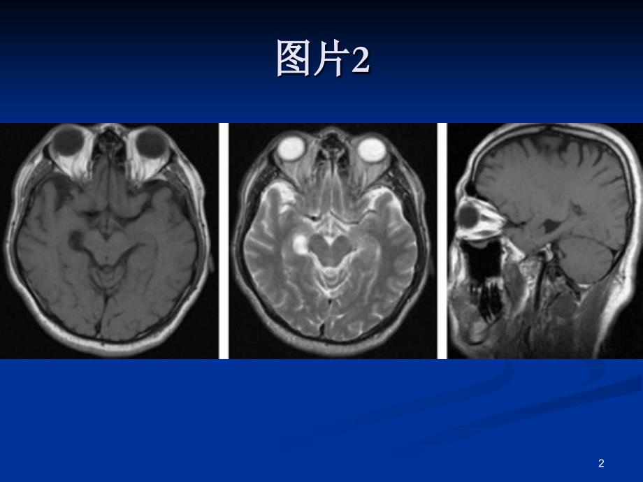 脉络膜裂囊肿&ampamp;脑血管周围间隙-文档资料_第2页