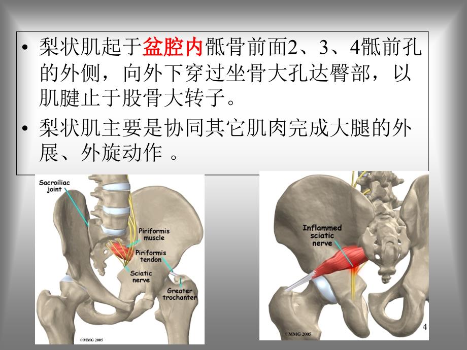 梨状肌综合征课件-文档资料_第4页