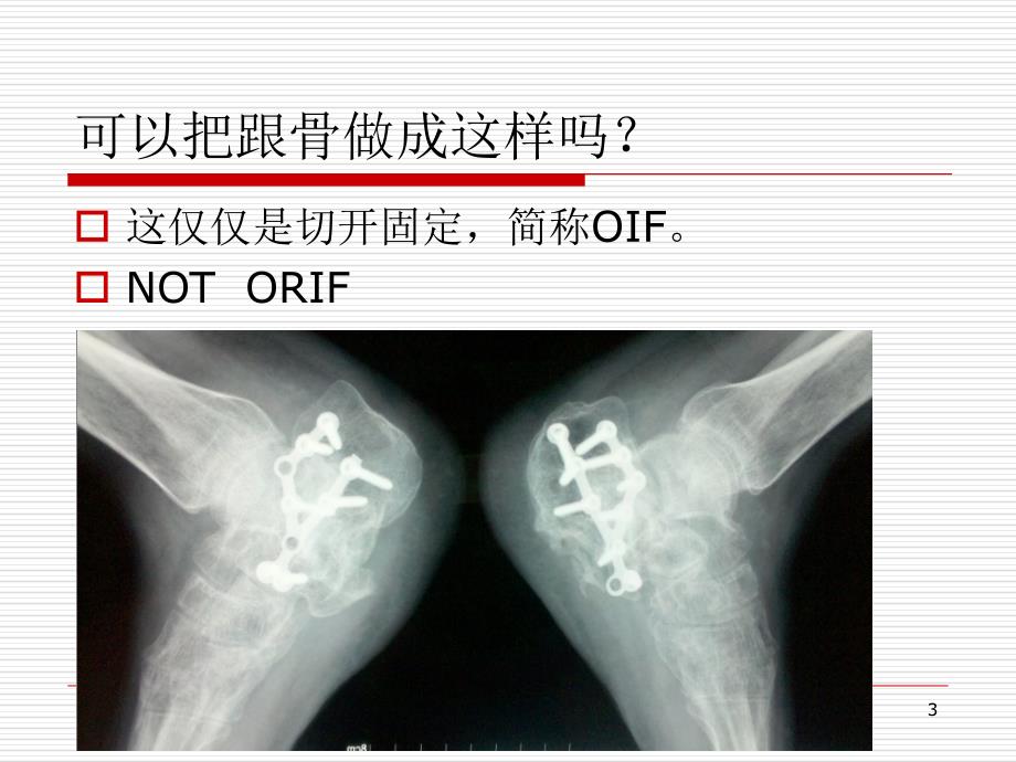 跟骨手术治疗技巧-文档资料_第3页