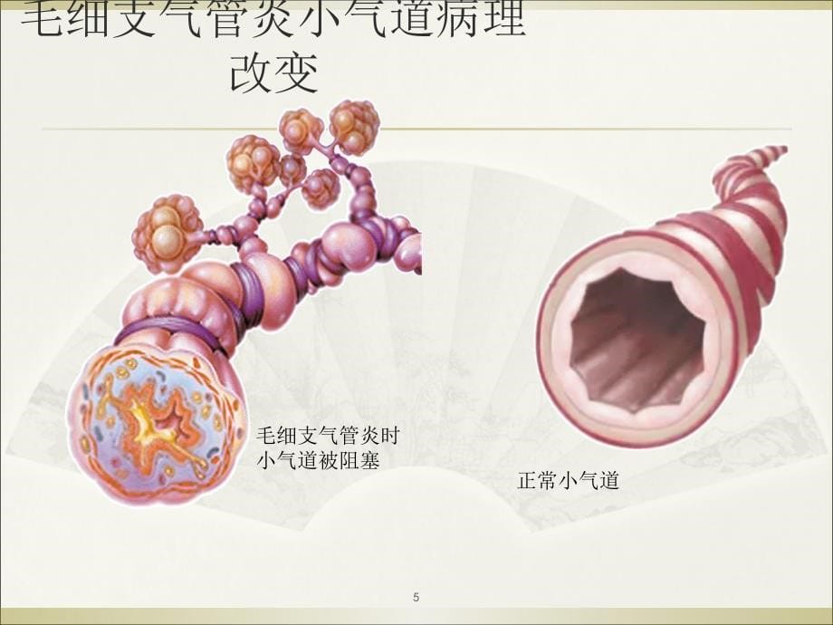 小儿毛细支气管炎的护理-文档资料_第5页