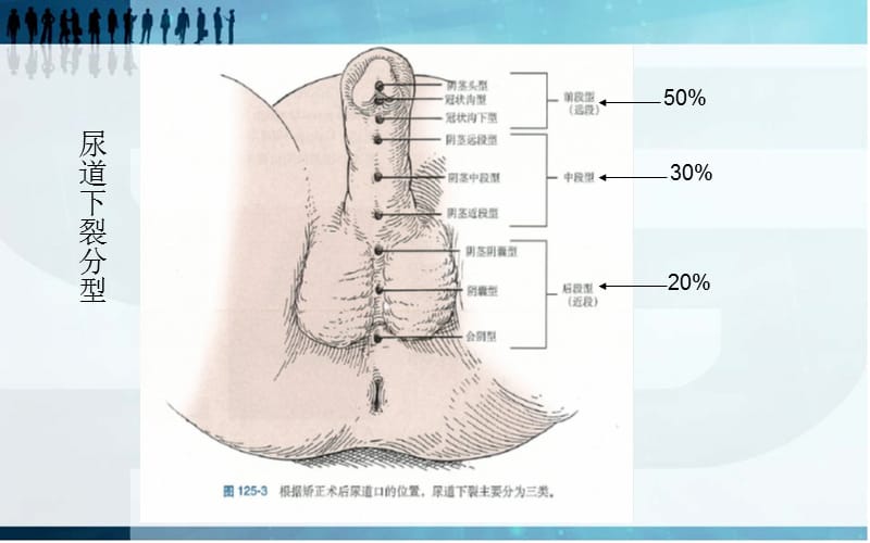 尿道下裂常用术式-文档资料_第5页