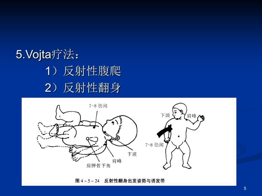 脑瘫儿童的全面康复-文档资料_第5页