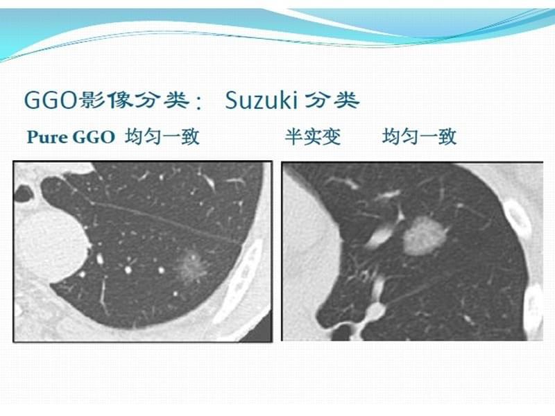 {战略管理}肺结节随访策略_第5页