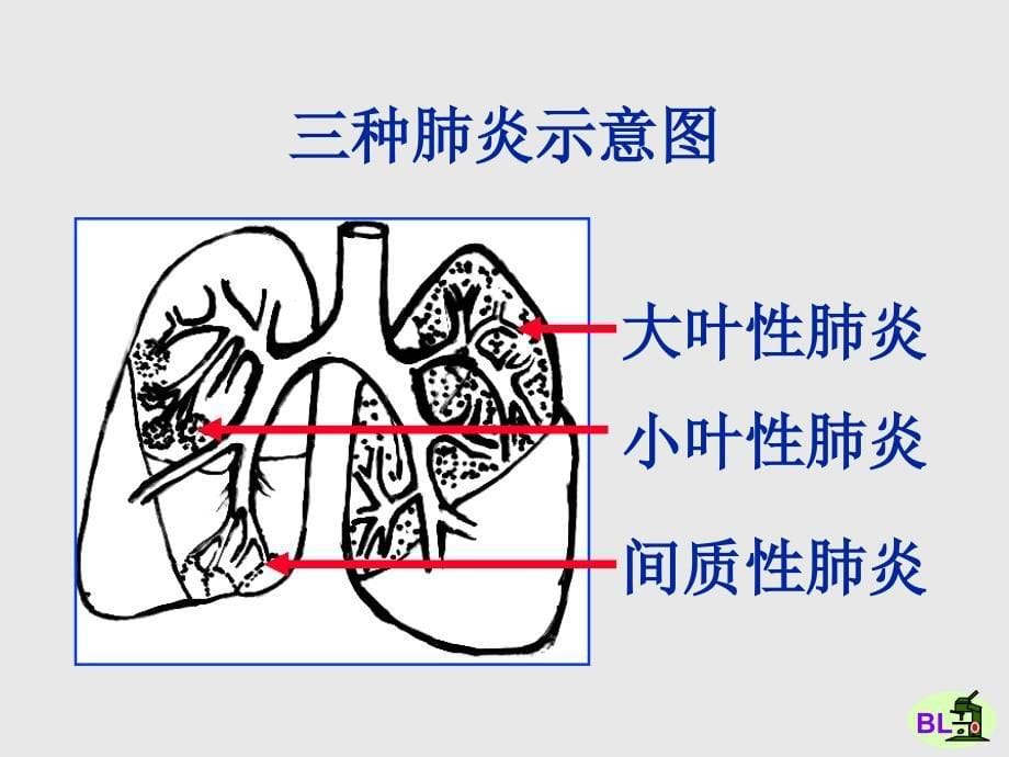 呼吸道和肺炎症性疾病肺炎知识讲解_第5页