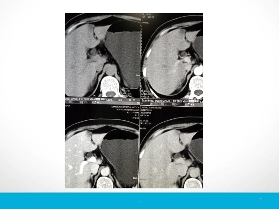 肝脏镰状韧带旁假病灶的CT表现PPT课件_第1页