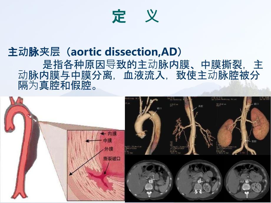 主动脉夹层诊断和治疗指南PPT课件_第3页