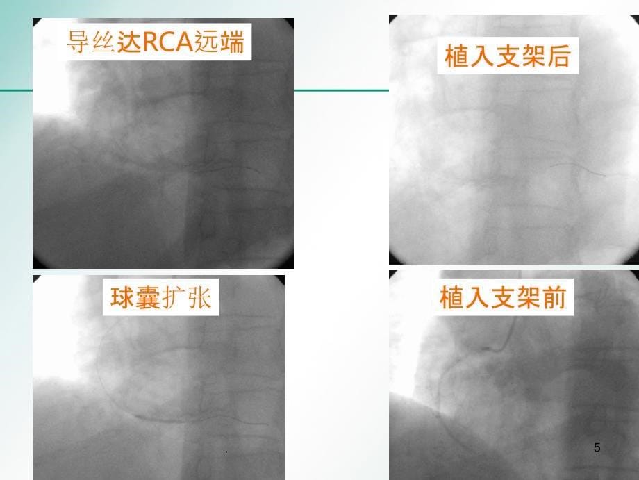 心肌梗死防治宣教刘洪智精品PPT课件_第5页