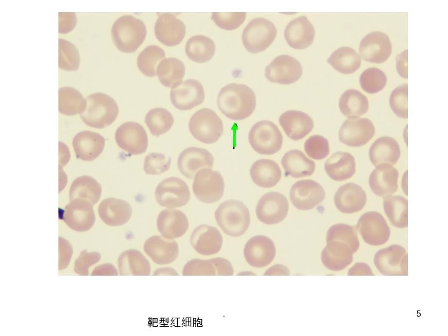 血液学检验典型细胞图谱PPT课件_第5页