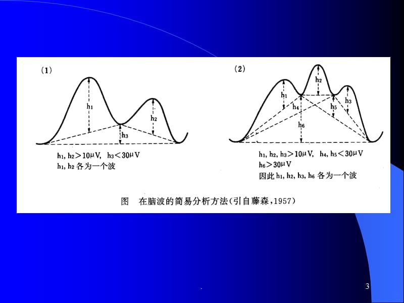 脑电图判读PPT课件_第3页