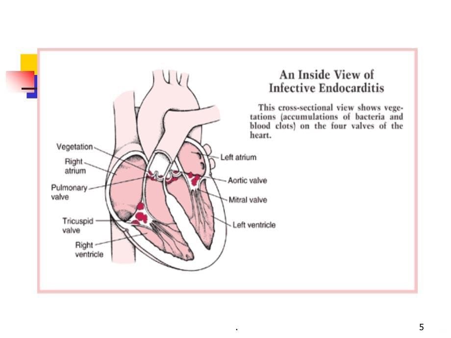 感染性心内膜炎新PPT课件_第5页
