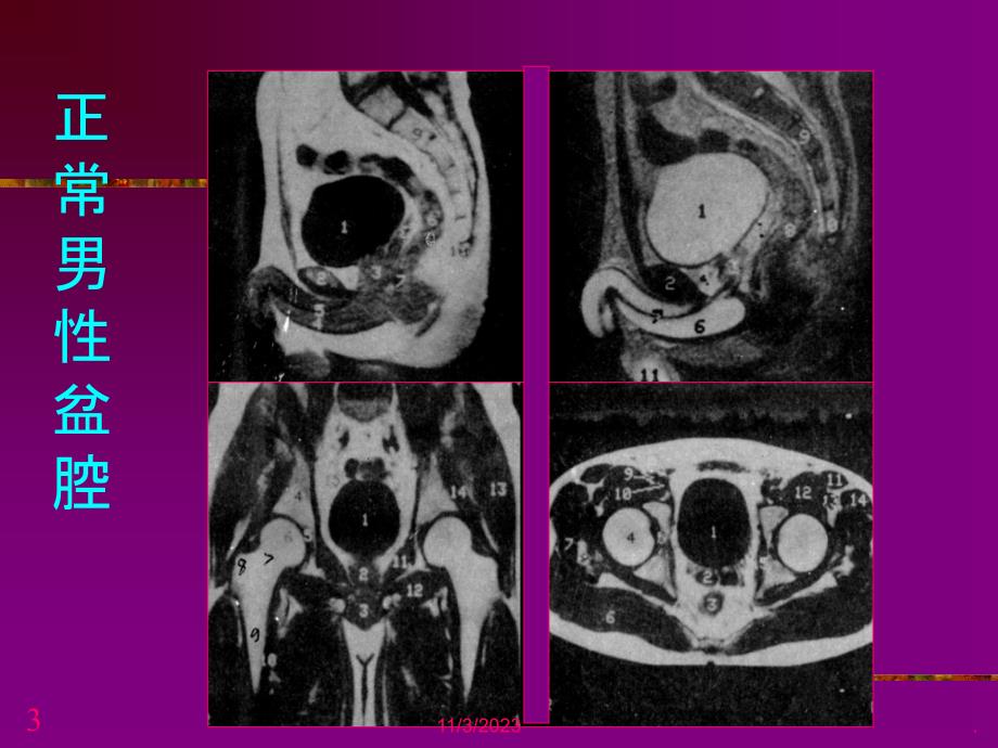 盆腔病变的MRI诊断PPT课件_第3页