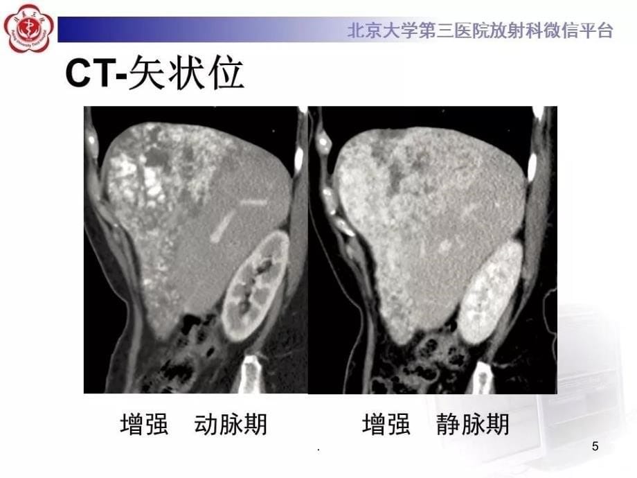 肝血管肉瘤PPT课件_第5页