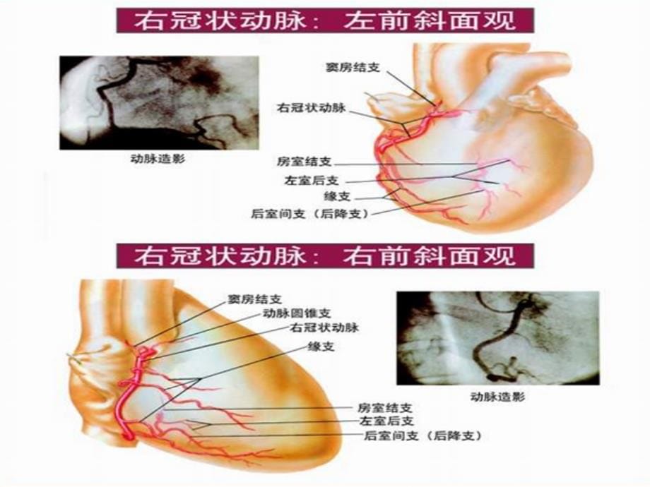 冠状动脉CTA后处理PPT课件_第5页