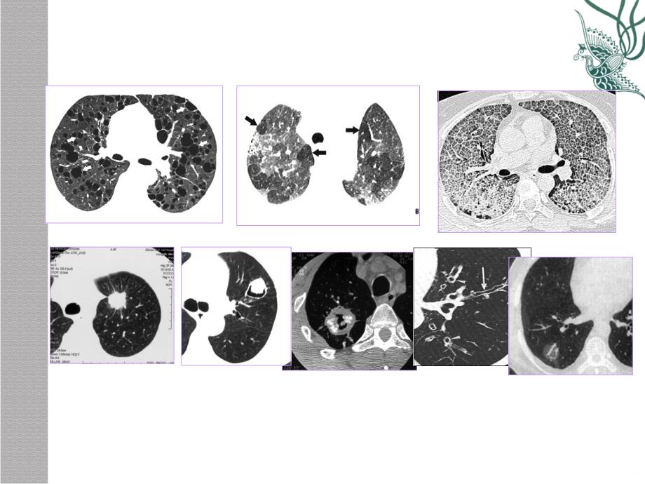 肺疾病的CT征象分析象PPT课件_第2页